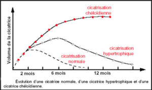 cicatrice-cheloide-chirurgie-esthetique