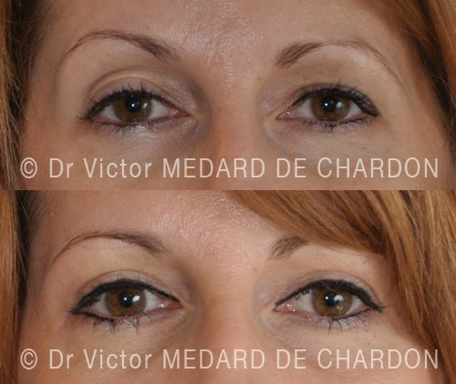 chirurgie esthetique paupieres alpes maritimes