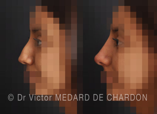 specialiste rhinoplastie sans chirurgie