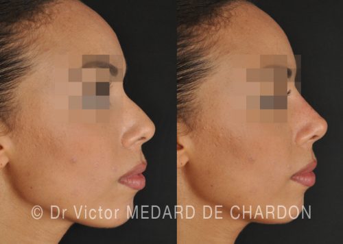 rhinoplastie medicale alpes maritimes var