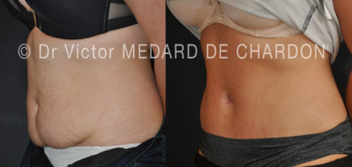 specialiste-abdominoplastie