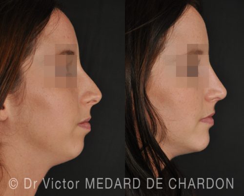 specialiste profiloplastie esthetique