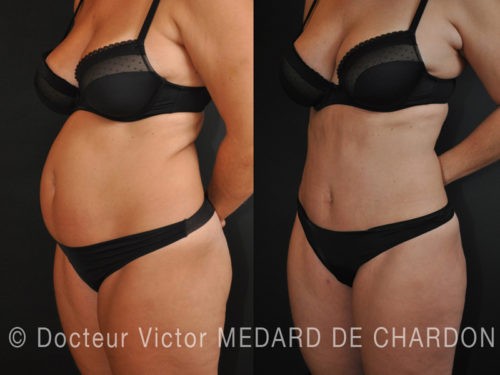 chirurgie esthetique ventre