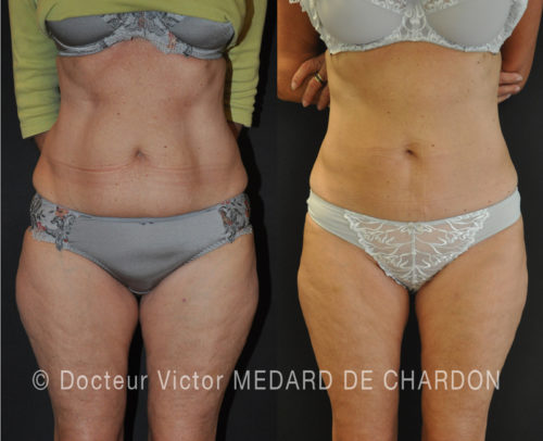 coolsculpting resultat