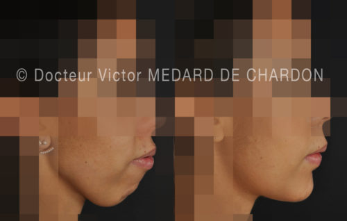 chirurgie reparatrice menton resultat