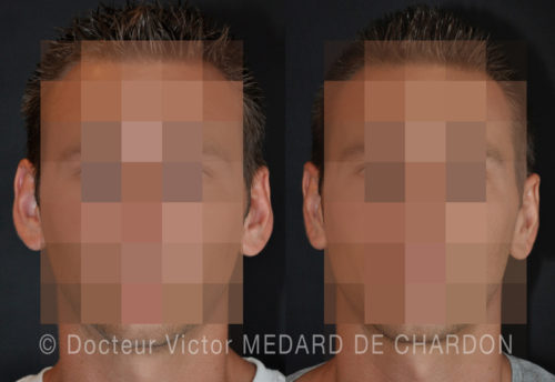 resultat naturel otoplastie