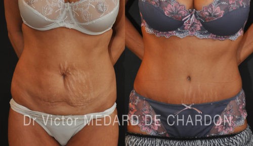 chirurgie-esthetique-ventre-resultat