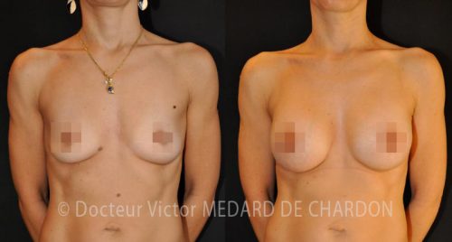specialiste augmentation mammaire alpes maritimes nice cannes