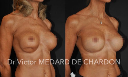 chirurgie esthetique rattrapage loupe augmentation mammaire