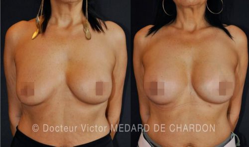 specialiste augmentation mammaire paca