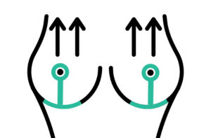 cicatrices-T-reduction-mammaire