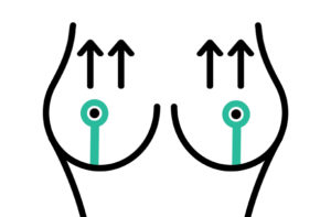 cicatrice-verticale-lifting-mammaire