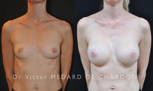 augmentation-mammaire-chirurgie-esthetique