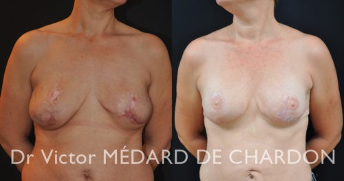 chirurgie-reparatrice-mammaire